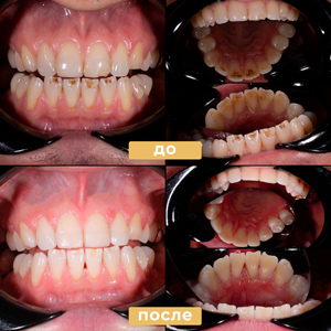 Профессиональная гигиена полости рта + реставрация передних резцов
